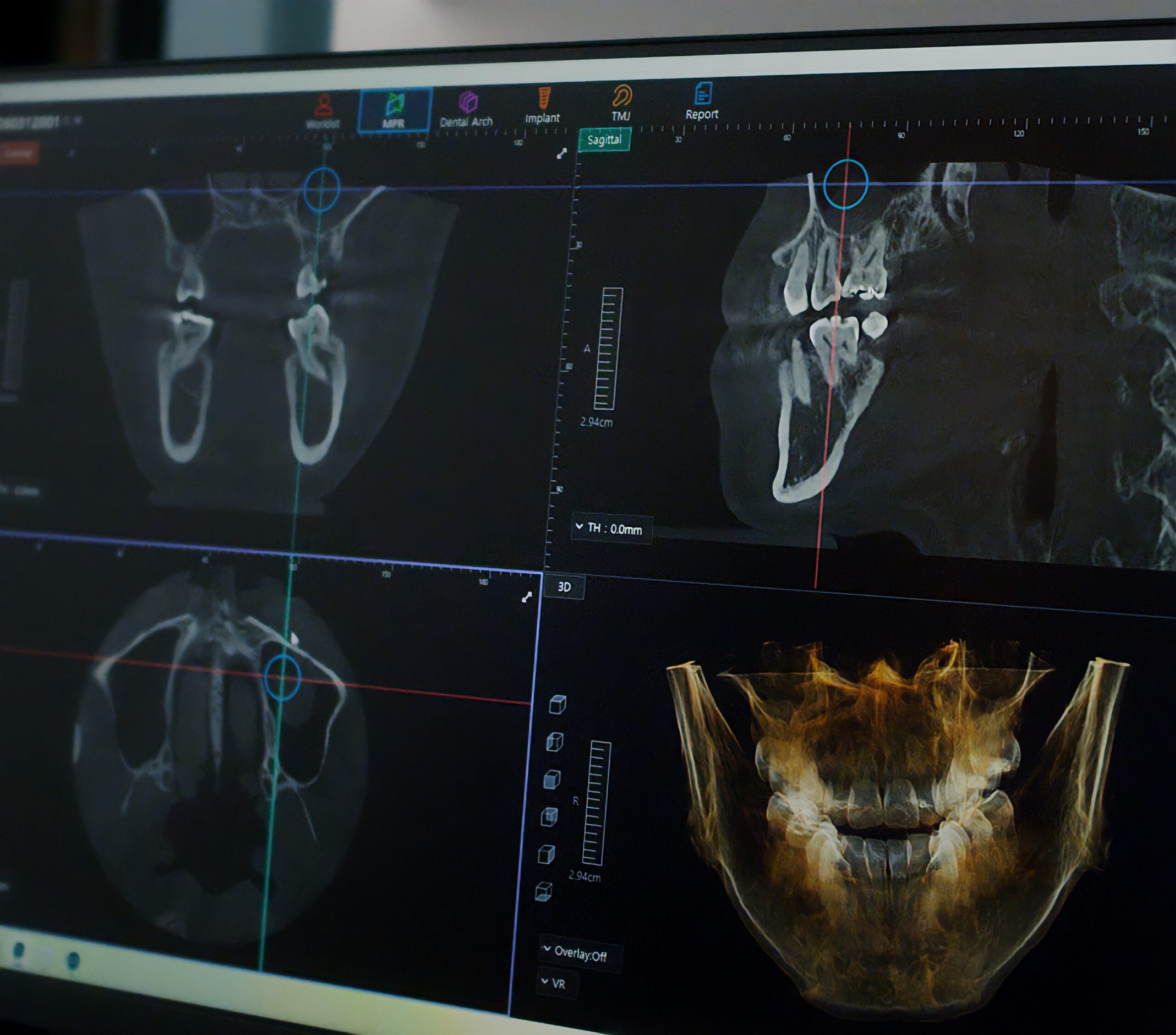 3D CBCT scan of the jaw on screen, used to plan dental implant placement at SmileCraft Dental
